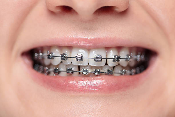 Braces and orthodontics